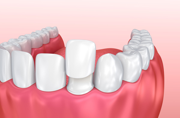 Image of jaw with dental teeth veneer being placed on tooth done at SmileCOS Dentistry in Colorado Springs.